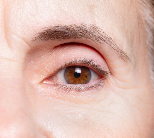 Softer crow&rsquo;s feet about two weeks after Botox