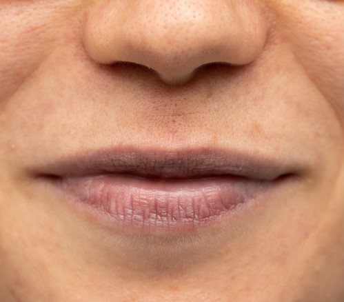 Upper lip before a Botox lip flip